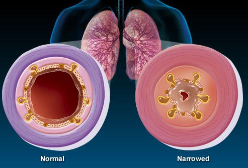 cause of bronchitis
