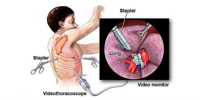 thoracoscopy