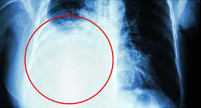 pleural specialist in mumbai
