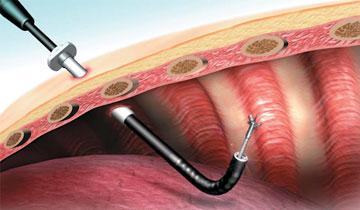 thoracoscopy