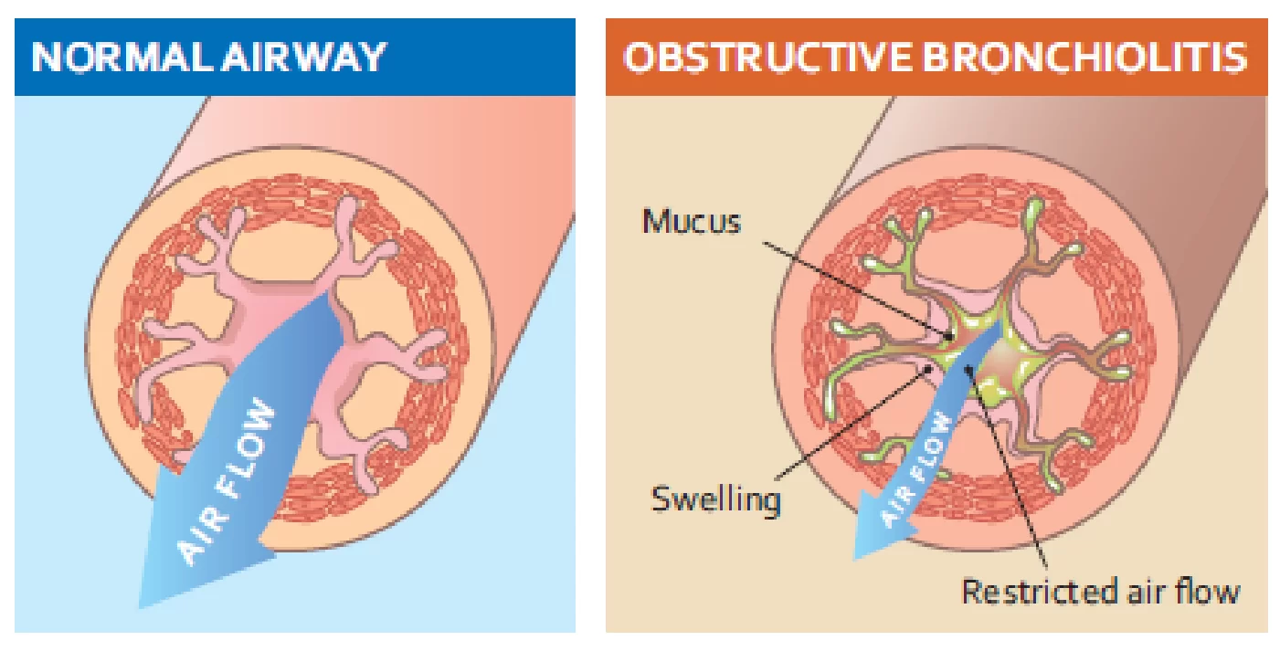 chronic obstructive pulmonary disease (COPD)