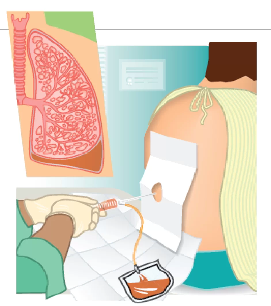 pleural tapping
