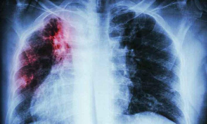 interstitial lung disease treatment at dr parthiv shah clinic