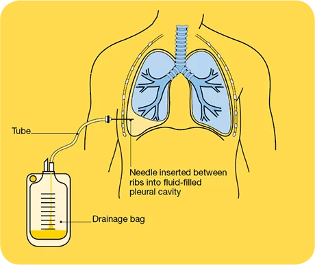 pleural tap / thoracentesis