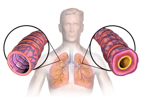 Asthma Specialist in Borivali