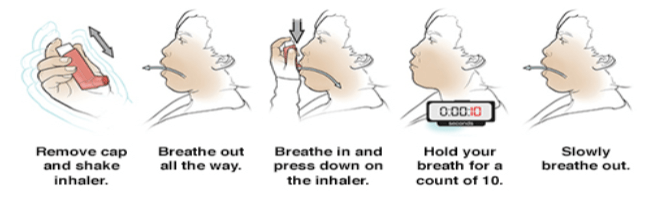 Metered-Dose Inhaler (MDI)