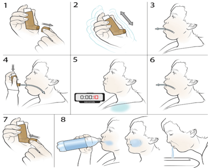 steps of Using steroid inhaler by asthma specialist in mumbai