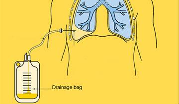 chesr tube thoracostomy