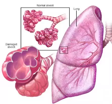 copd