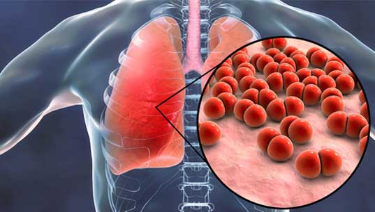 pneumonia doctor in borivali