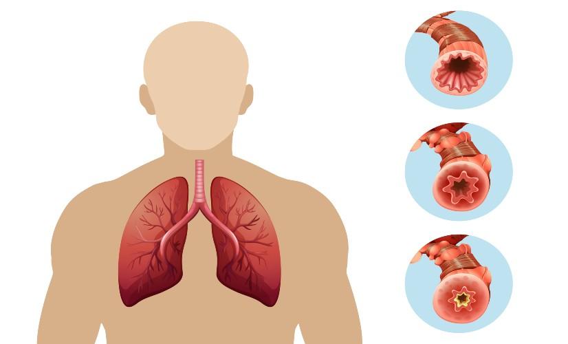 What is Pulmonary Embolism and Why it is necessary to consult the Physician?