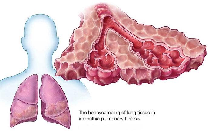 Lung Fibrosis Doctor in Mumbai - Dr. Parthiv Shah