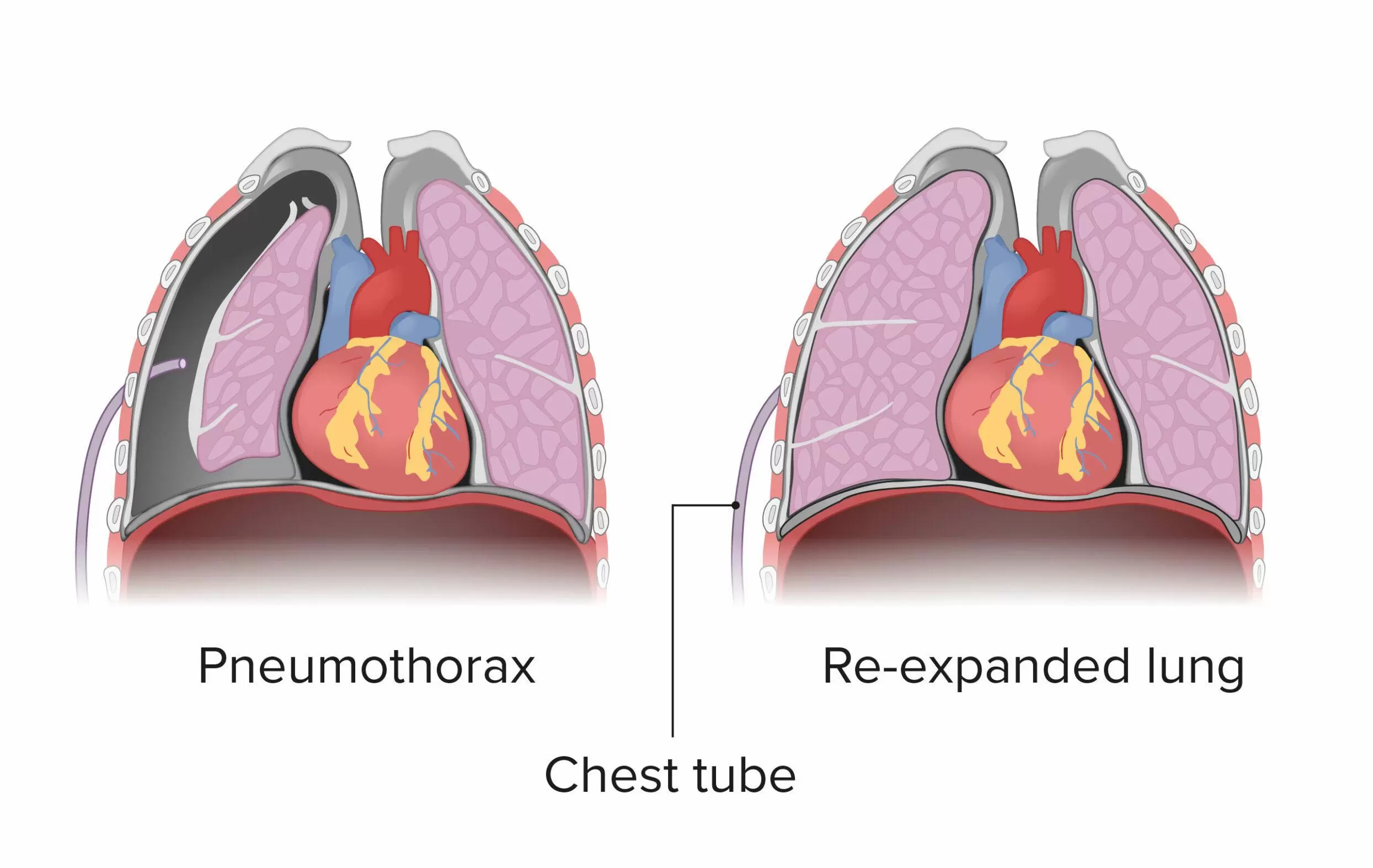 pleural effusion specialist in mumbai