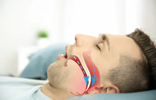 Obstructive Sleep Apnea