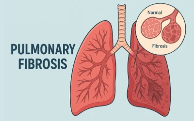 Pulmonary Fibrosis: What is It, Causes, Symptoms, Risk and Treatment?